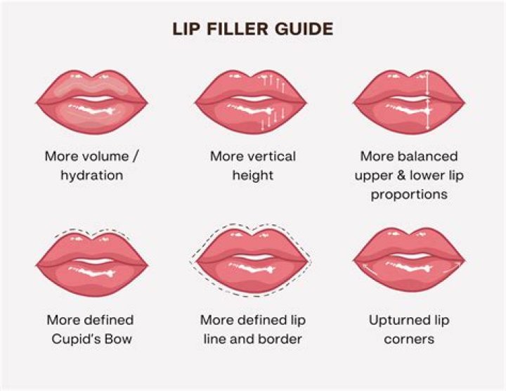 Lip filler shape guide - How To Discuss
