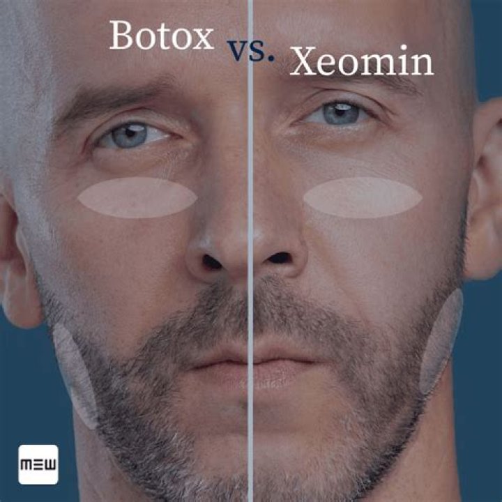 Xeomin vs botox - How To Discuss